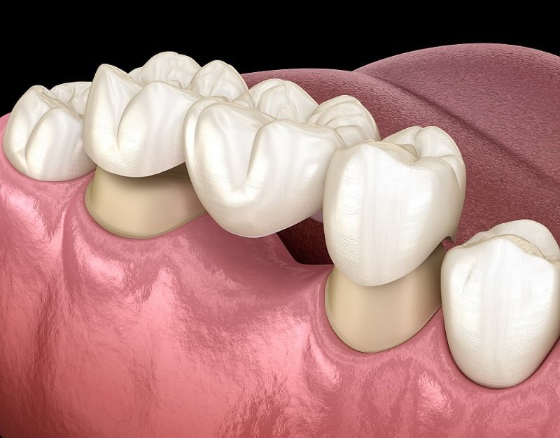 traditional dental bridges