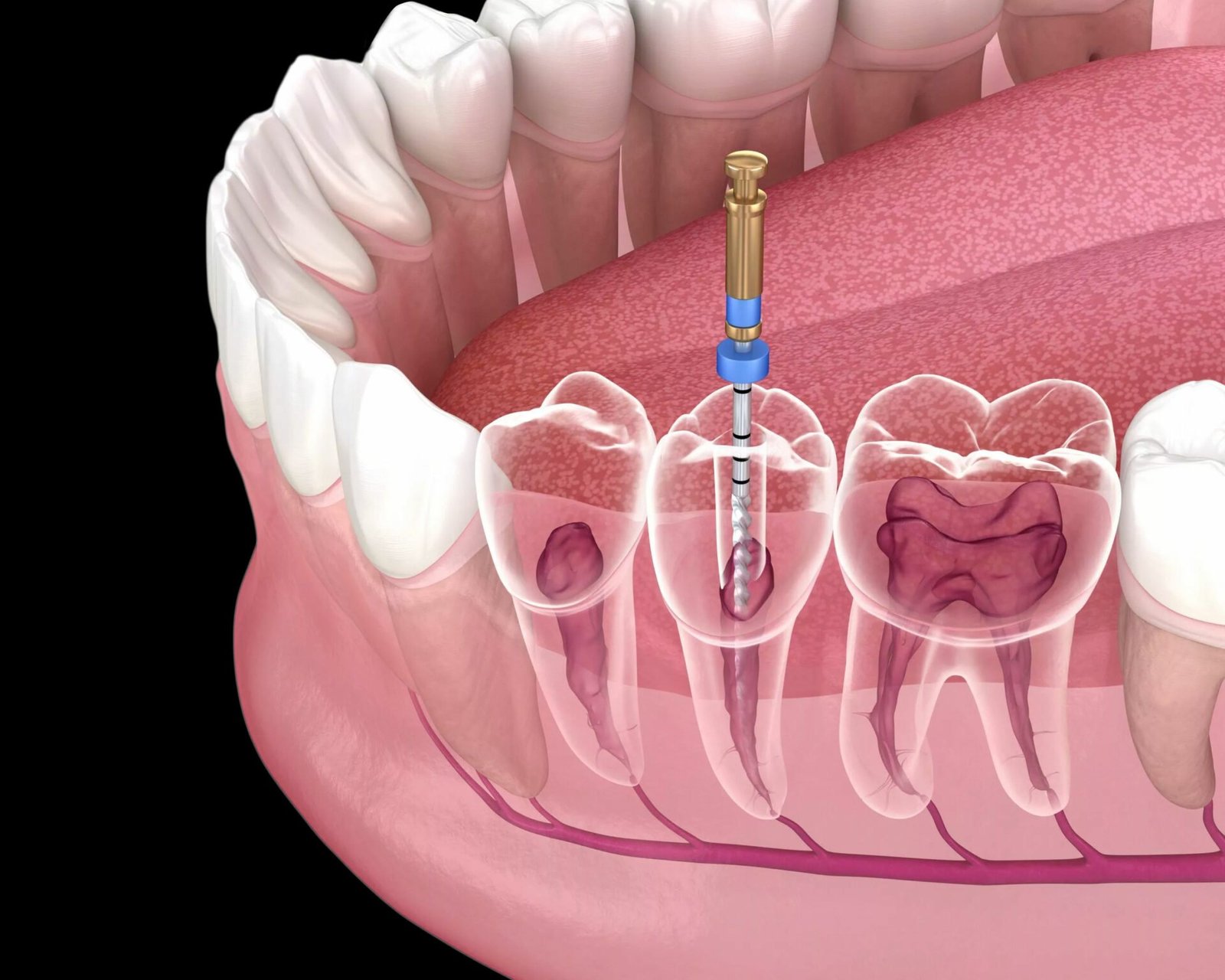 endodontic root canal treatment process medically scaled 1