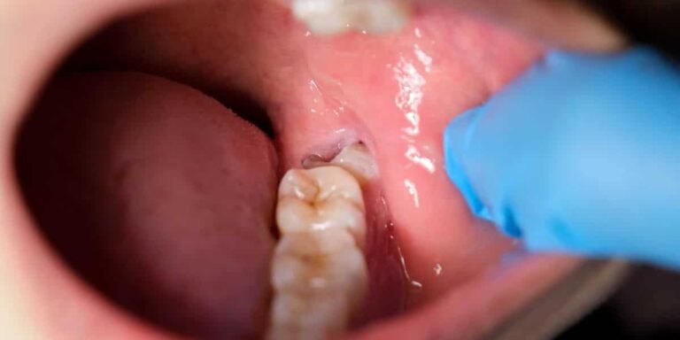 when to remove wisdom teeth