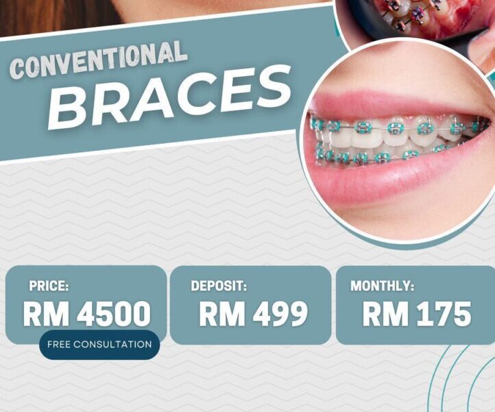Conventional Braces