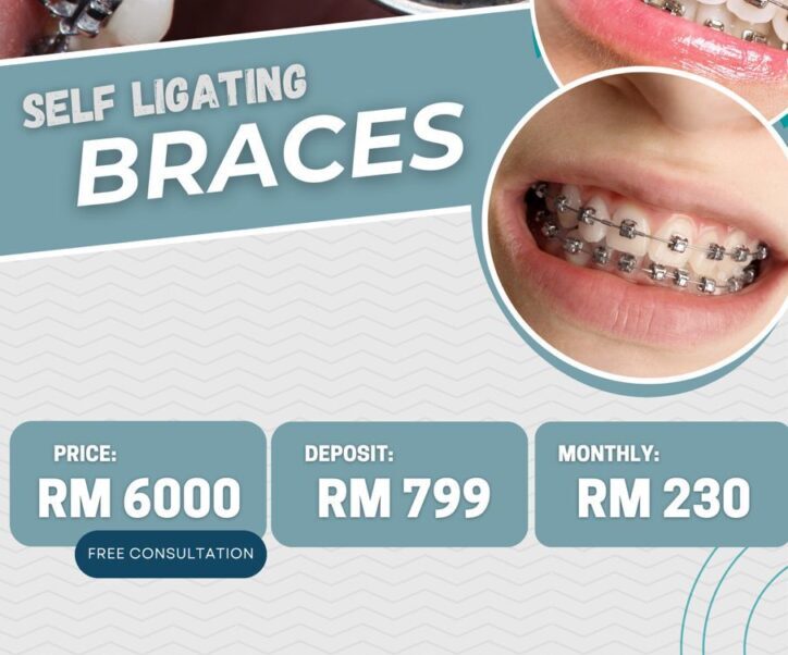 Self Ligating Braces